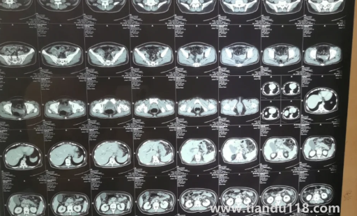 胰腺不舒服早期大便會(huì)變化嗎(胰腺有問題會(huì)不會(huì)打嗝)(圖2) 胰腺不舒服早期大便會(huì)變化嗎2