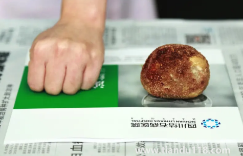 腎結石3mm需要治療嗎3