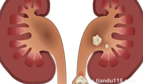腎結石3mm×3mm多大2