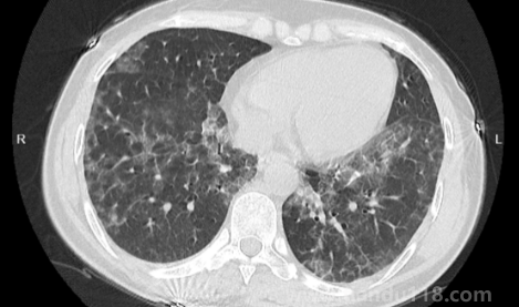 如何自查是否出現(xiàn)白肺（肺白了還能恢復(fù)嗎）
